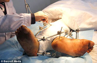 Người có hai... chân phải!