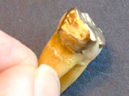 Thoát chết nhờ... răng vàng