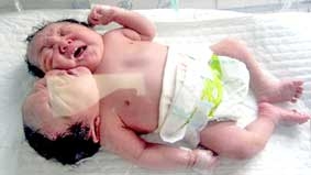 Bé gái có 2 đầu