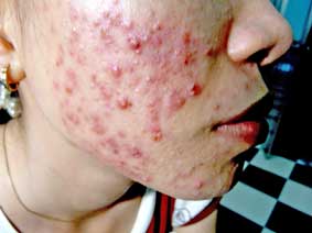 Những hậu quả khó lường do sử dụng kem trộn