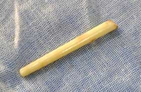 Đũa nằm 11 năm trong mắt