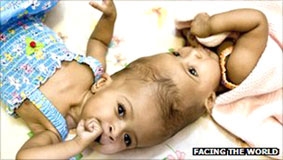 Tách thành công cặp song sinh dính liền đầu