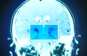 Hy vọng mới trong điều trị Parkinson