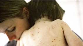 Ánh nắng có thể ngăn bệnh 
thủy đậu lây lan