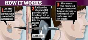 Trị ung thư da 
không cần phẫu thuật