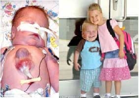 Vẫn sống với nửa trái tim 
bên ngoài cơ thể