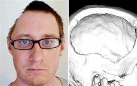 Vá đầu bằng... mỡ bụng