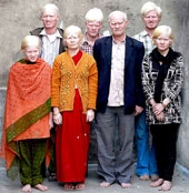 Gia đình bạch tạng