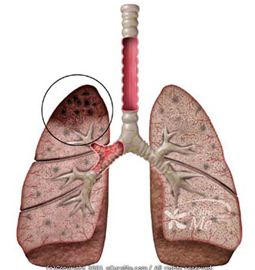 Triển vọng mới trong phòng ngừa và điều trị bệnh lao