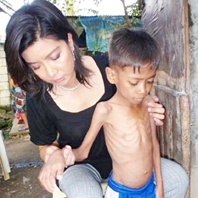 Hơn 70.000 trẻ em chết mỗi năm vì bệnh lao