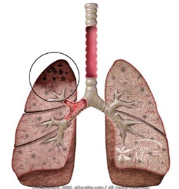 Triển vọng mới trong phòng ngừa và điều trị bệnh lao