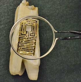 “Xăm” răng để chẩn đoán bệnh