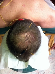 Châm cứu bằng xung điện có thể chữa bệnh trầm cảm hiệu quả