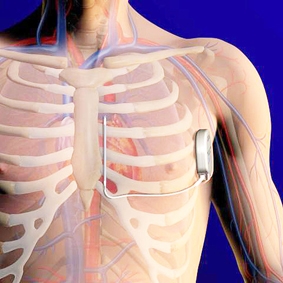 Máy khử rung tim mới  tin vui cho bệnh nhân loạn nhịp tim