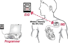 Thiết bị cảnh báo sớm cơn đau tim