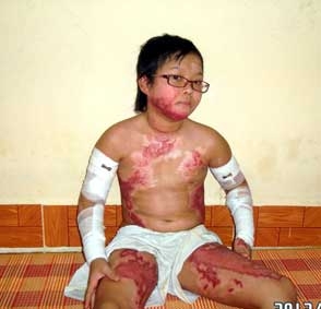 Xin giúp cô bé học giỏi điều trị thương tích