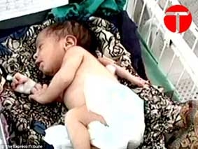 Bé gái Pakistan chào đời với 3 cánh tay