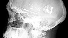 Võng mạc điện tử giúp khôi phục thị lực ở người mù