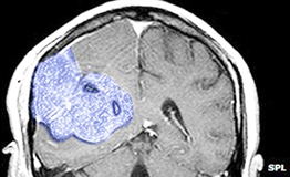 Tế bào gốc giúp bảo vệ mô khỏe mạnh trong quá trình xạ trị