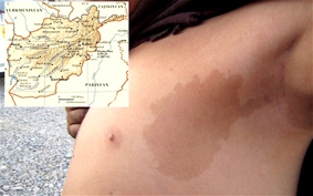 Đổi đời nhờ vết bớt hình bản đồ