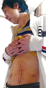 Bùng nổ nạn buôn bán thận trái phép trên thế giới