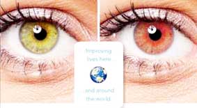 Kính áp tròng giúp
cảnh báo đường huyết
ở bệnh nhân tiểu đường