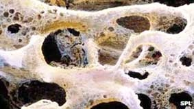 Phương pháp mới giúp phát hiện sớm bệnh loãng xương