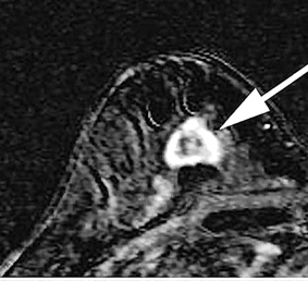 “Bom thông minh” tấn công
tế bào ung thư vú