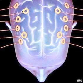 Chẩn đoán tự kỷ sớm ở trẻ bằng điện não đồ