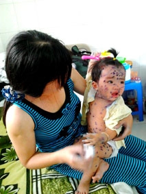 Chủ động phòng ngừa bệnh thủy đậu