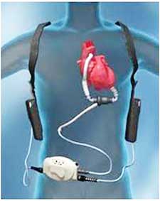 Hy vọng sống cho những
bệnh nhân suy tim nặng