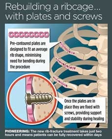 Synthes Rib Matrix  phương pháp phẫu thuật mới giúp xương gãy mau hồi phục