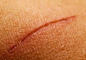 Tuyến mồ hôi đóng vai trò 

quan trọng trong việc làm 

lành vết thương