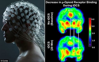 Kích thích điện não giúp 
chữa chứng đau nửa đầu mãn tính
