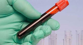 Xét nghiệm máu giúp chẩn đoán nguy cơ tái phát ung thư vú