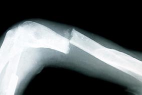 Loại nhựa mới giúp chữa lành xương gãy