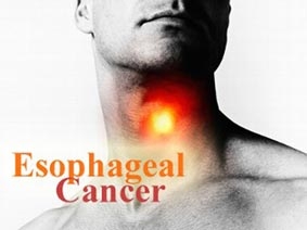 Phát hiện các biến thể gien gây ung thư thực quản