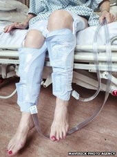 "Vớ" chống đông máu dành cho bệnh nhân đột quị