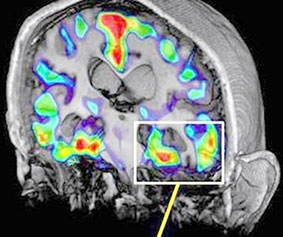 Kỹ thuật quét não mới 
phát hiện sớm tác nhân 
gây bệnh Alzheimer