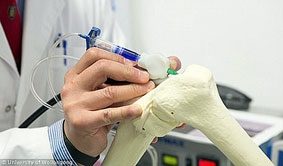 Viết BioPen hỗ trợ tái tạo xương