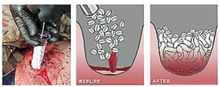 Cầm máu trong 15 giây 
bằng ống tiêm bọt biển