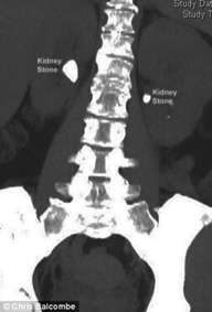 Phương pháp mới cho phép tán sỏi ở hai thận cùng lúc