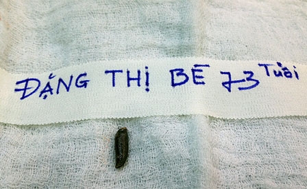 Một số lưu ý đối với các trường hợp 
phẫu thuật lấy dị vật