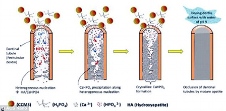 Vật liệu mới bảo vệ răng nhạy cảm dài lâu