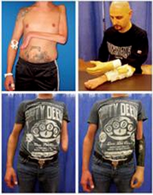 Lắp thành công tay sinh học