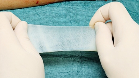 Gạc sinh học chứa tế bào da 

làm lành nhanh vết phỏng