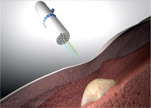 Kỹ thuật mới nâng cao khả năng điều trị ung thư bằng thuốc