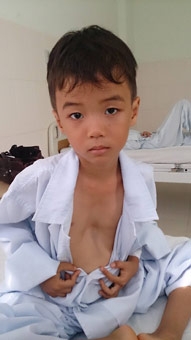Điều trị hai ca lõm xương ngực
bẩm sinh