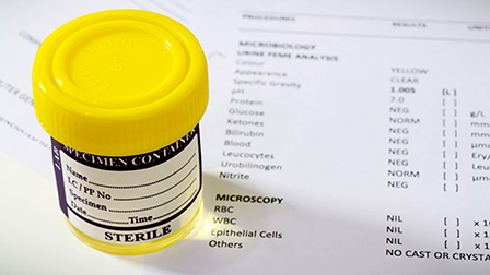 Xét nghiệm nước tiểu có thể chẩn đoán viêm gan C