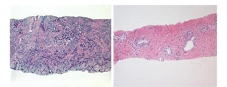 “Liệu pháp gien tự sát” tiêu diệt hiệu quả tế bào ung thư tuyến tiền liệt